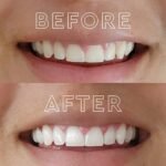 Teeth Whitening Toothpaste Alternatives