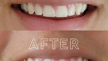 Teeth Whitening Toothpaste Alternatives